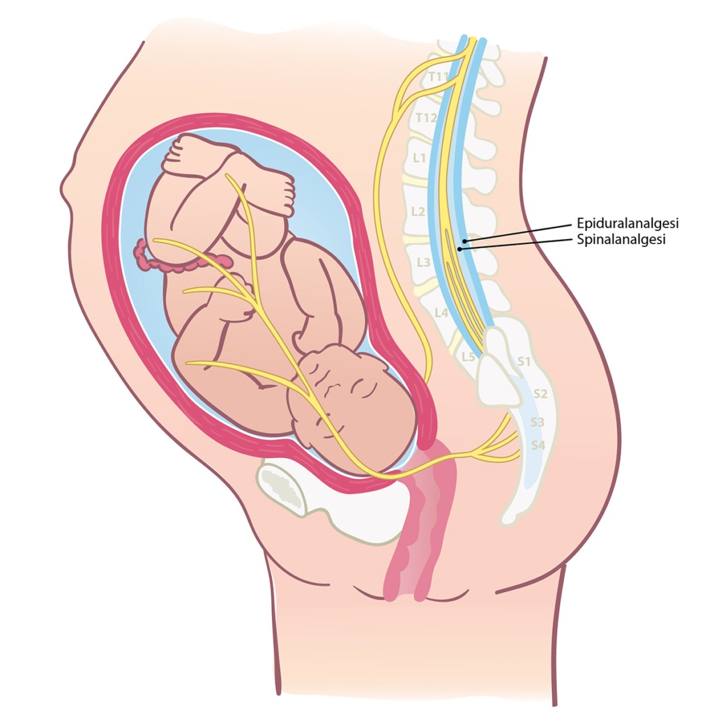 Illustration som visar vart sätter bedövning i ryggen vid barnafödesel