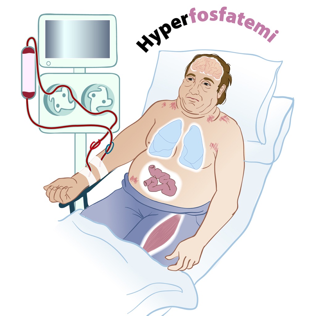 Illustration som visar symptom vid elektrolytrubbningar i kroppen. Hyperfosfatemi.