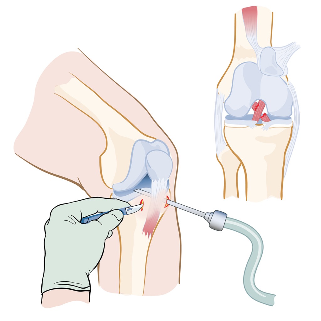 Illustration som visar en korsbandsoperation i kneet. Kirurgi.