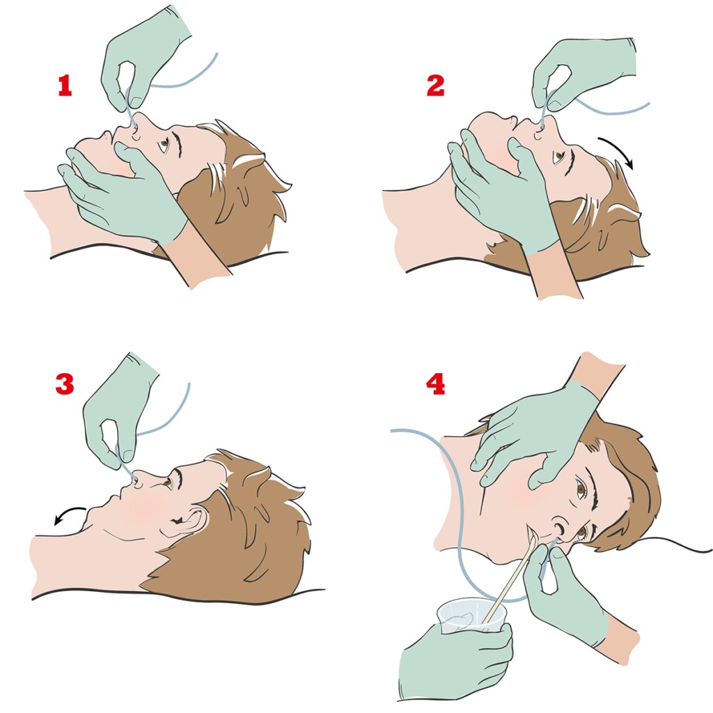 Illustration som visar hur man lägger in en sond på en patient