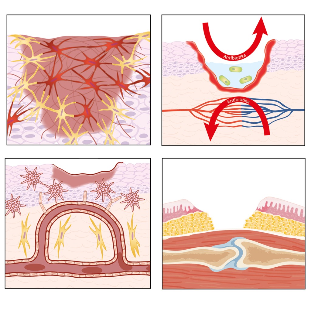 Illustration som visar olika stadier vid sårbehandling och läkningsfysiologi.