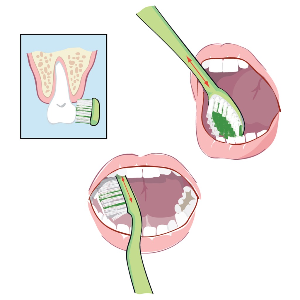 Illustration som visar tandbostning.